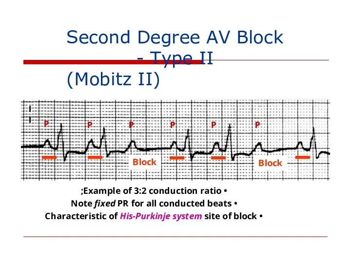 II P P P P P P Second Degree AV