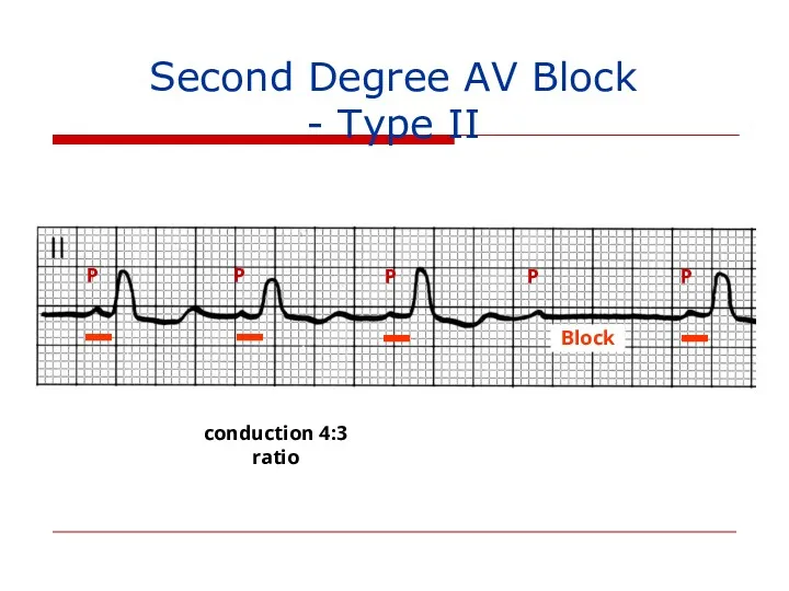 Second Degree AV Block - Type II P P P P P 4:3 conduction ratio Block