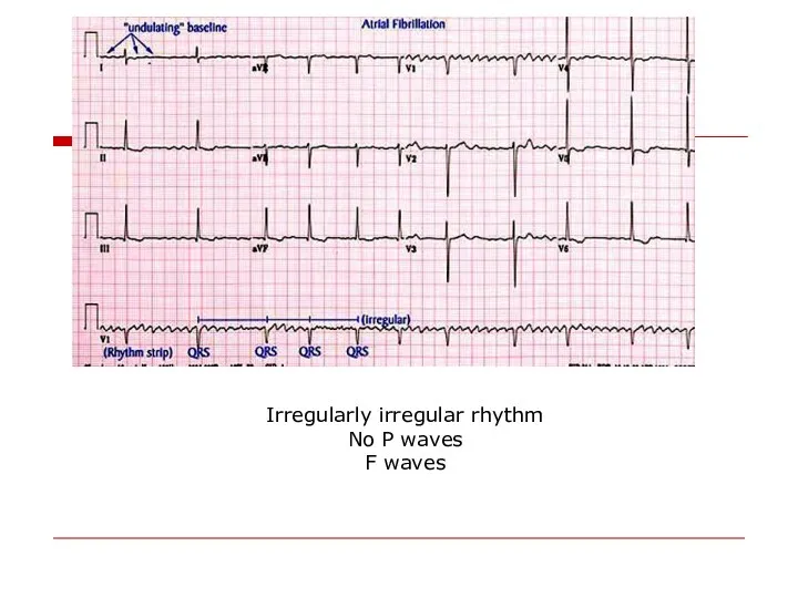 Irregularly irregular rhythm No P waves F waves