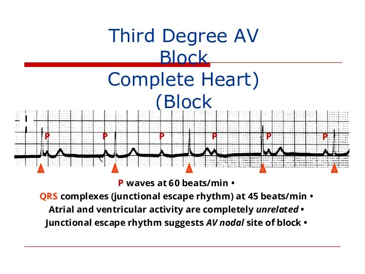 Third Degree AV Block (Complete Heart Block) P P P