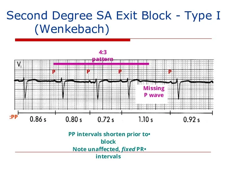 Second Degree SA Exit Block - Type I (Wenkebach) P