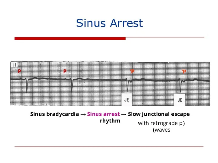 P P P’ P’ Sinus bradycardia → Sinus arrest →