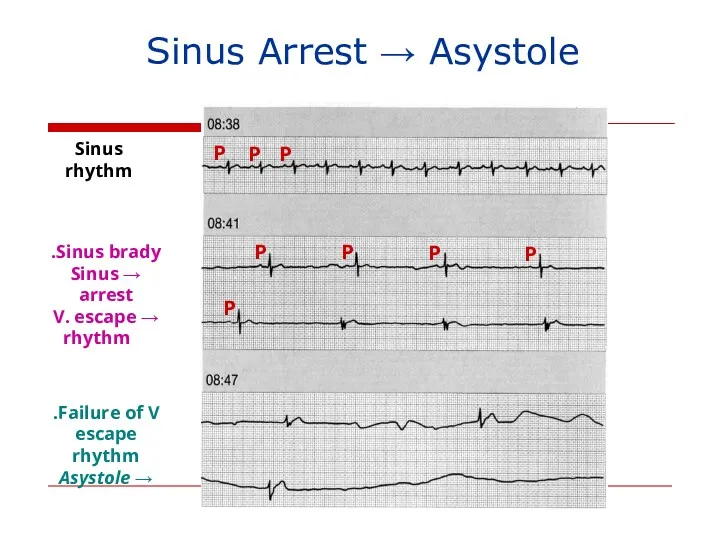 Sinus Arrest → Asystole Sinus rhythm Sinus brady. → Sinus