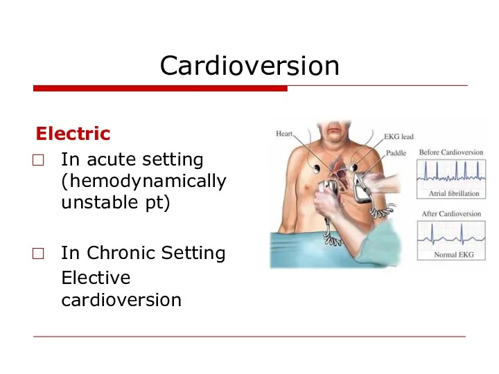 Cardioversion Electric In acute setting (hemodynamically unstable pt) In Chronic Setting Elective cardioversion