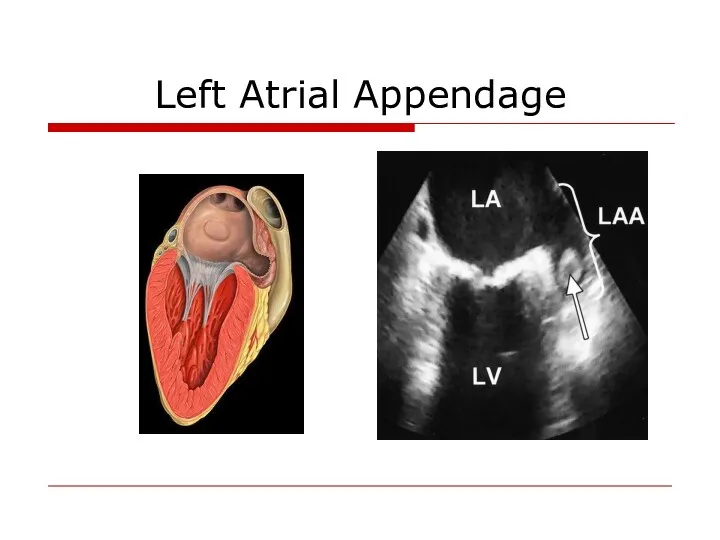 Left Atrial Appendage