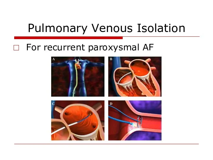 Pulmonary Venous Isolation For recurrent paroxysmal AF