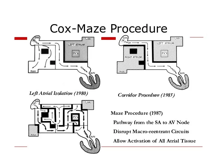 Cox-Maze Procedure Left Atrial Isolation (1980) Corridor Procedure (1985) Maze