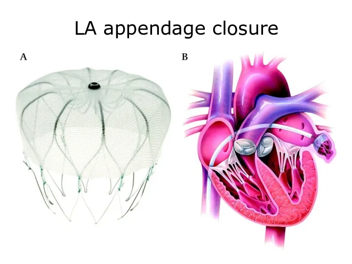 LA appendage closure