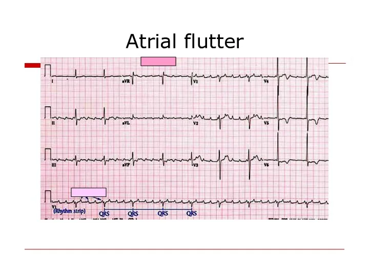 Atrial flutter