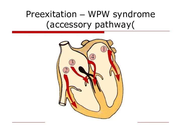 Preexitation – WPW syndrome (accessory pathway(