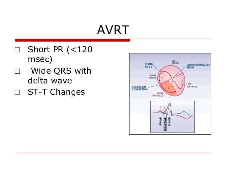 AVRT Short PR ( Wide QRS with delta wave ST-T Changes