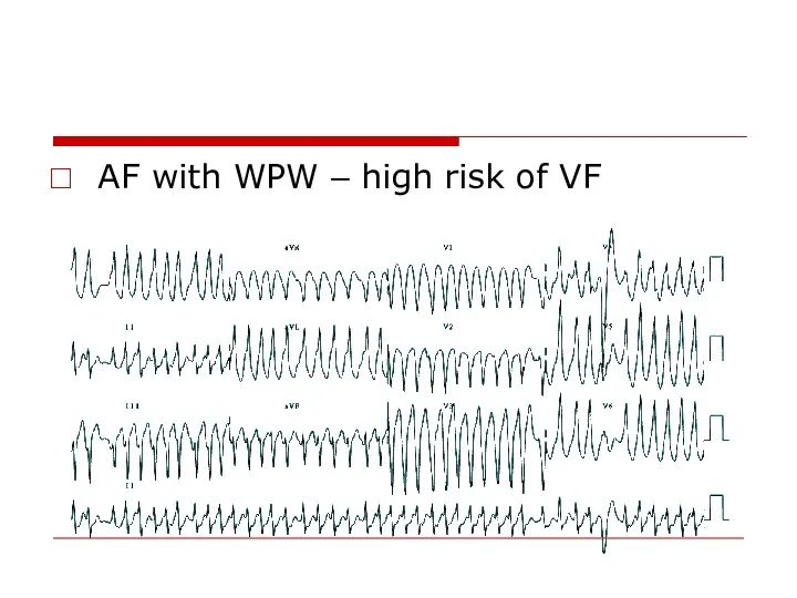 AF with WPW – high risk of VF