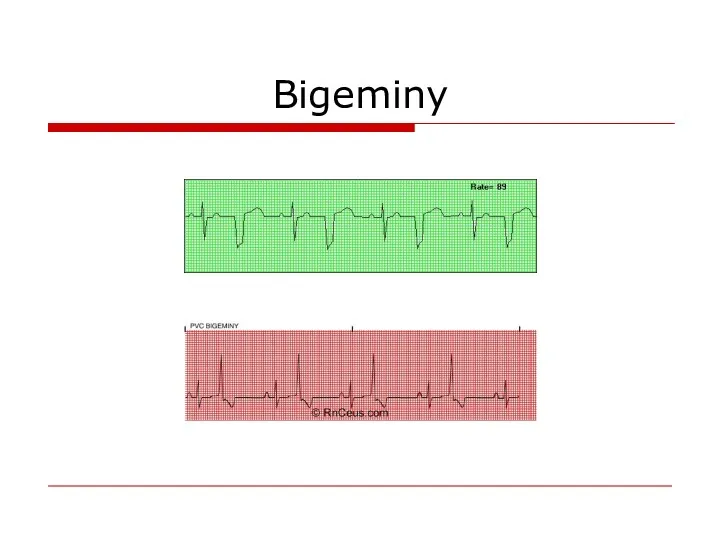 Bigeminy