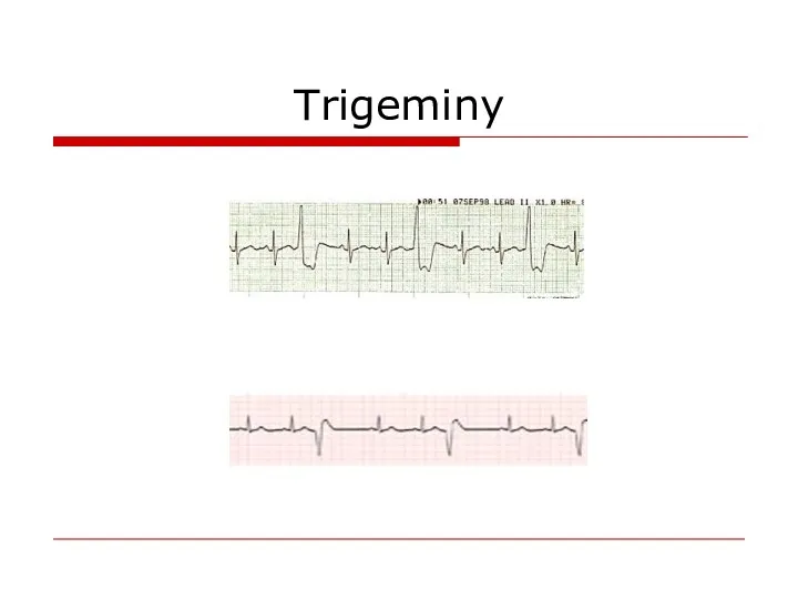 Trigeminy