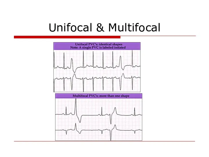 Unifocal & Multifocal