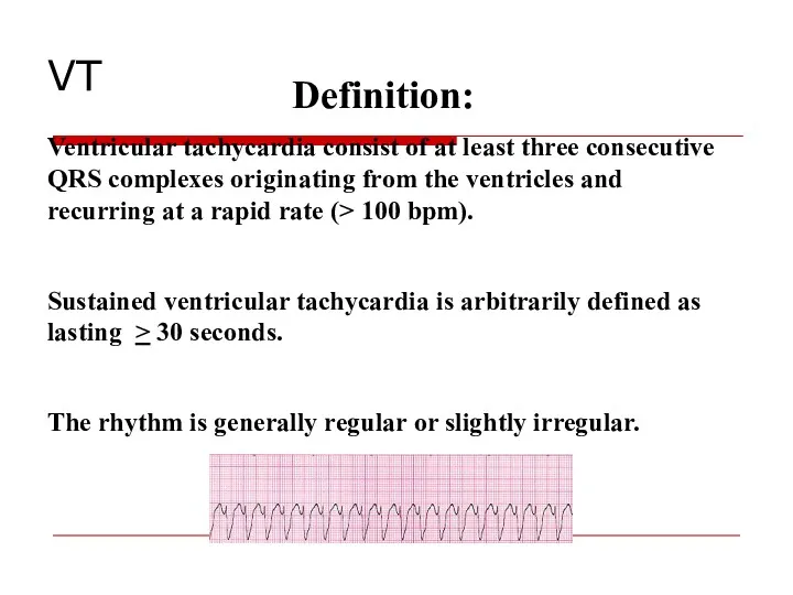 Definition: Ventricular tachycardia consist of at least three consecutive QRS