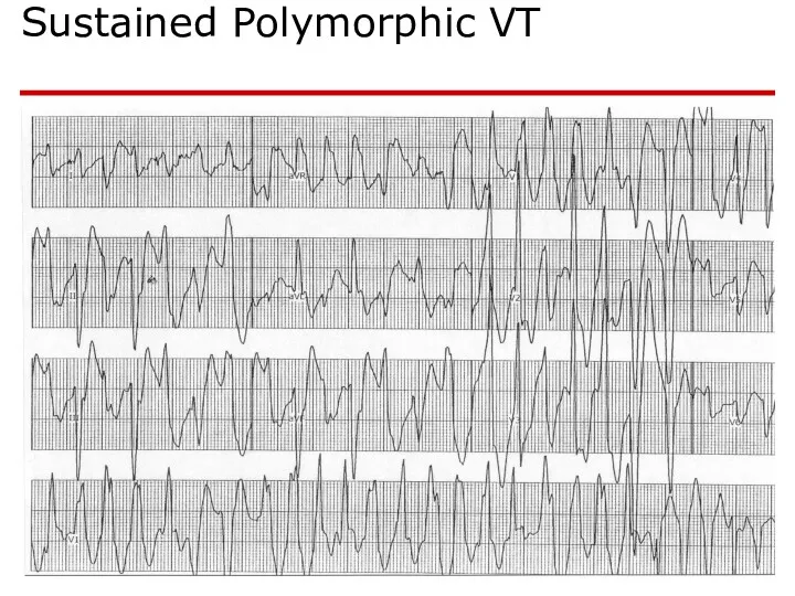 Sustained Polymorphic VT