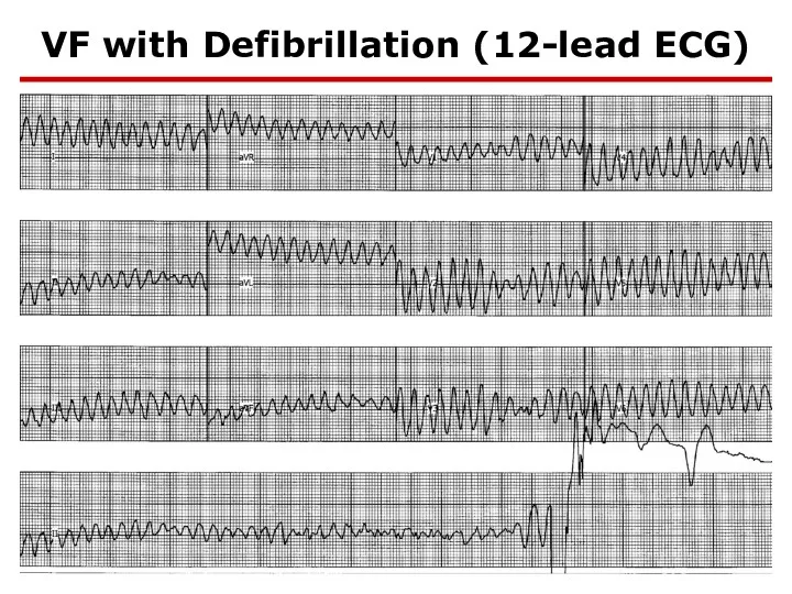 VF with Defibrillation (12-lead ECG)