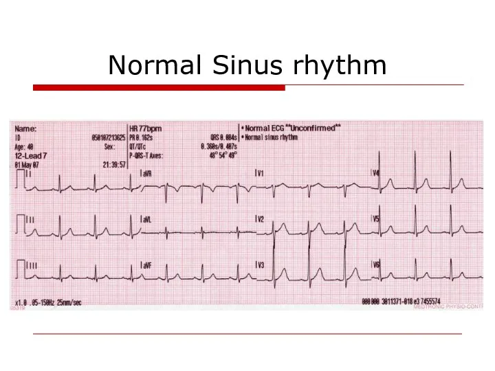 Normal Sinus rhythm