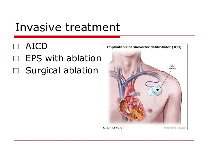 Invasive treatment AICD EPS with ablation Surgical ablation