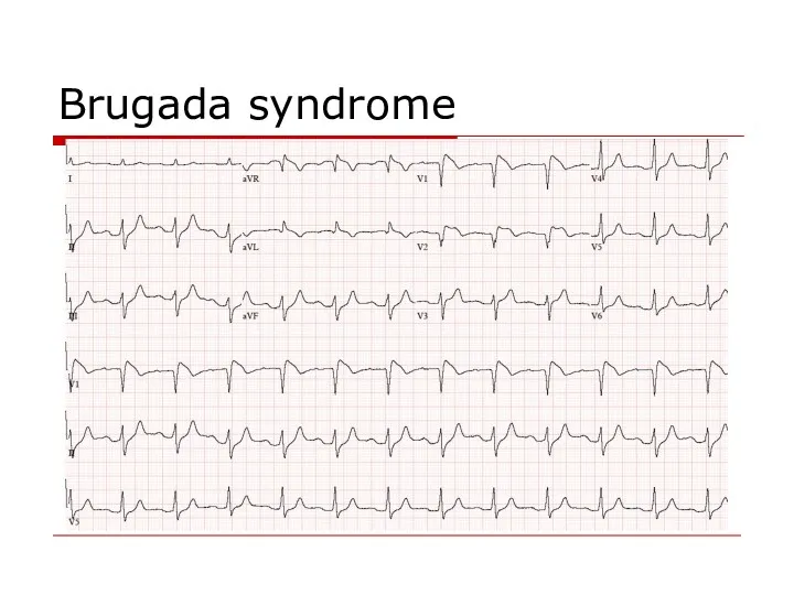 Brugada syndrome