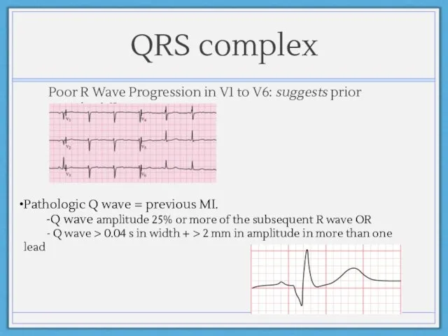 QRS complex Poor R Wave Progression in V1 to V6: