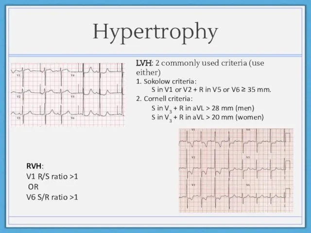 Hypertrophy RVH: V1 R/S ratio >1 OR V6 S/R ratio
