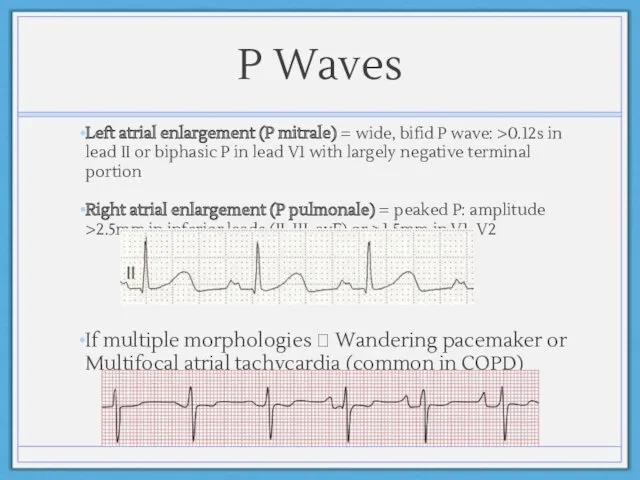 P Waves Left atrial enlargement (P mitrale) = wide, bifid