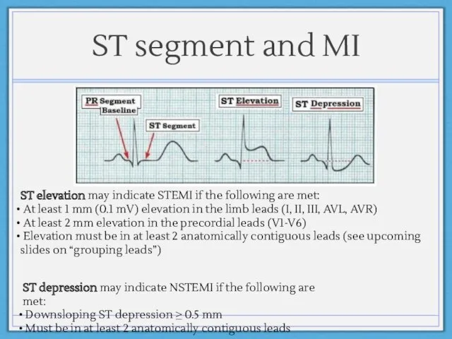 ST segment and MI ST elevation may indicate STEMI if