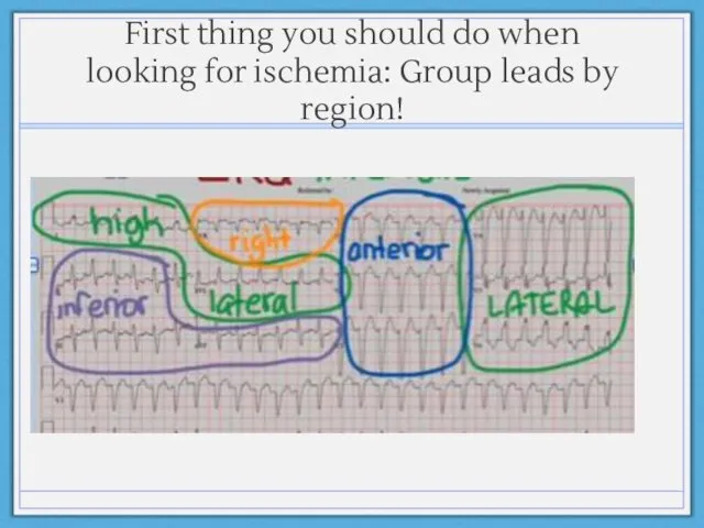 First thing you should do when looking for ischemia: Group leads by region!