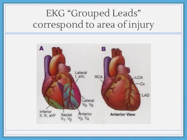 EKG “Grouped Leads” correspond to area of injury