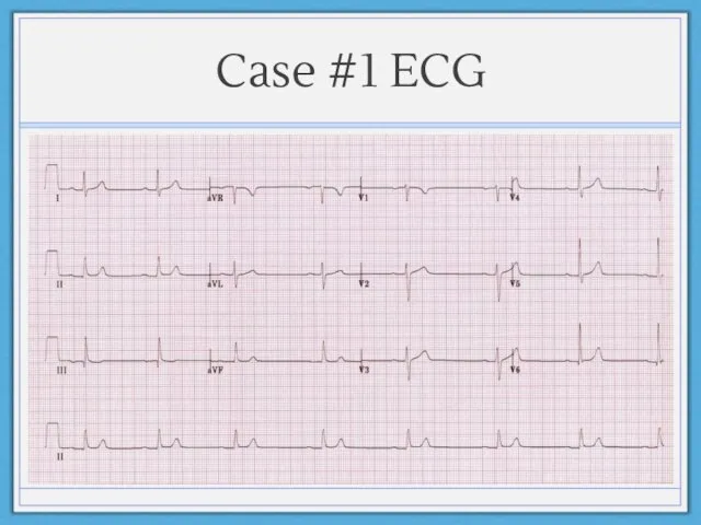 Case #1 ECG