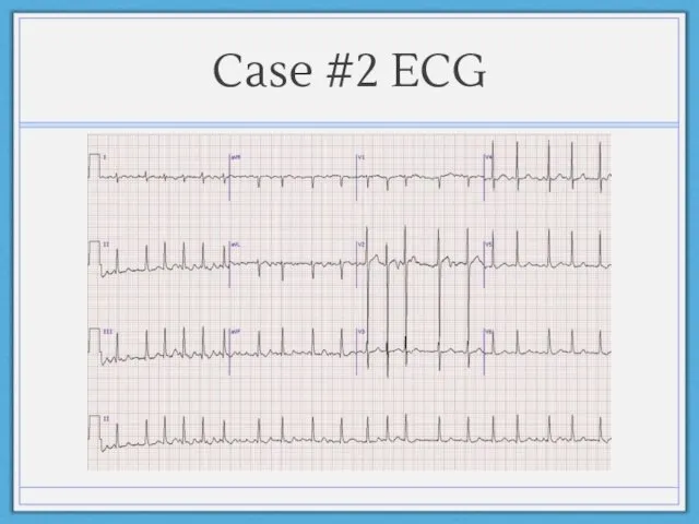 Case #2 ECG