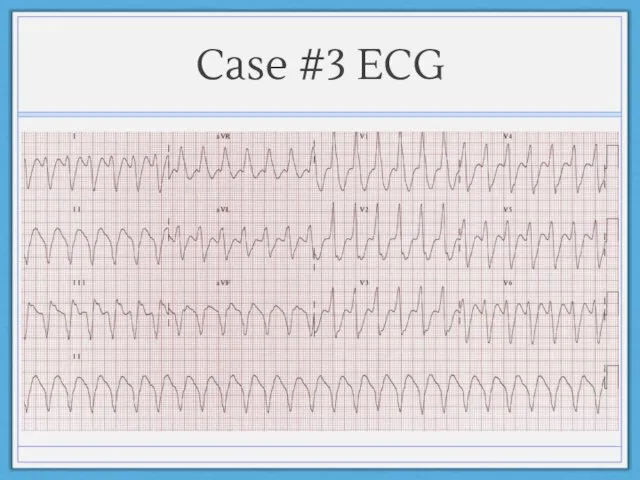 Case #3 ECG