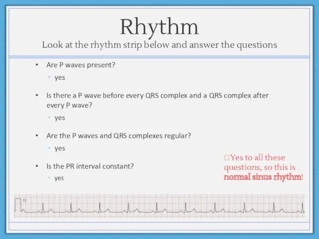 Rhythm Look at the rhythm strip below and answer the