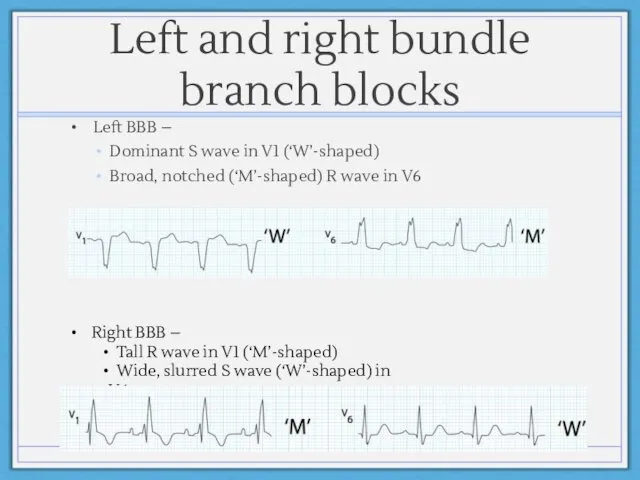 Left and right bundle branch blocks Left BBB – Dominant