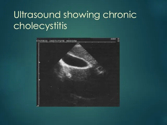 Ultrasound showing chronic cholecystitis