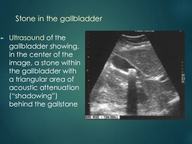 Stone in the gallbladder Ultrasound of the gallbladder showing, in