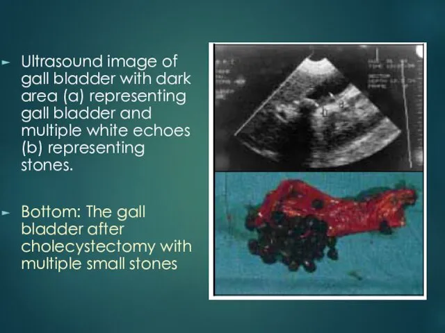 Ultrasound image of gall bladder with dark area (a) representing