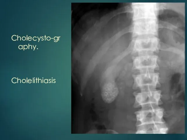 Cholecysto-graphy. Cholelithiasis