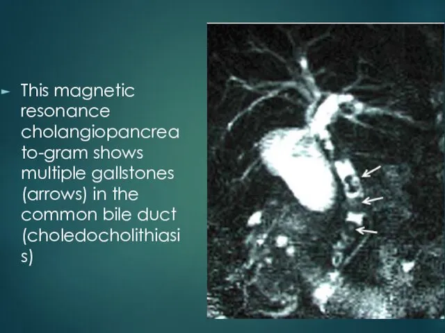 This magnetic resonance cholangiopancreato-gram shows multiple gallstones (arrows) in the common bile duct (choledocholithiasis)