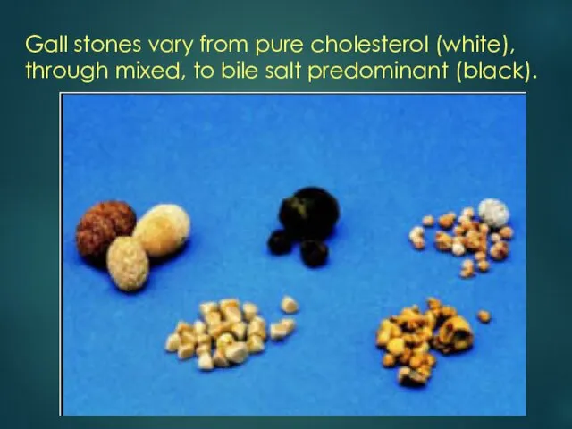 Gall stones vary from pure cholesterol (white), through mixed, to bile salt predominant (black).