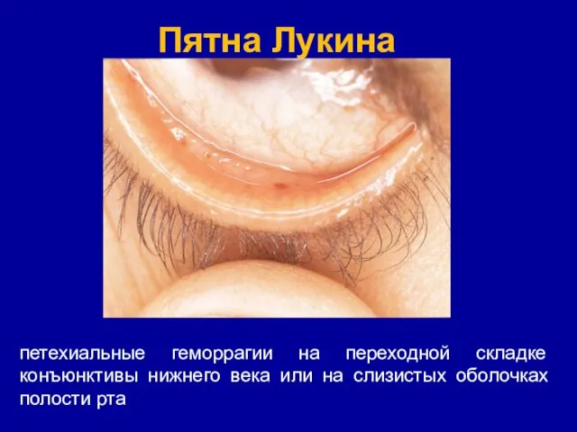 Пятна Лукина петехиальные геморрагии на переходной складке конъюнктивы нижнего века или на слизистых оболочках полости рта