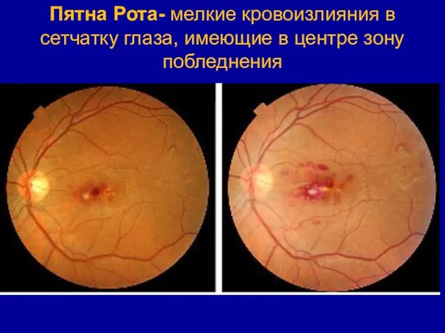 Пятна Рота- мелкие кровоизлияния в сетчатку глаза, имеющие в центре зону побледнения