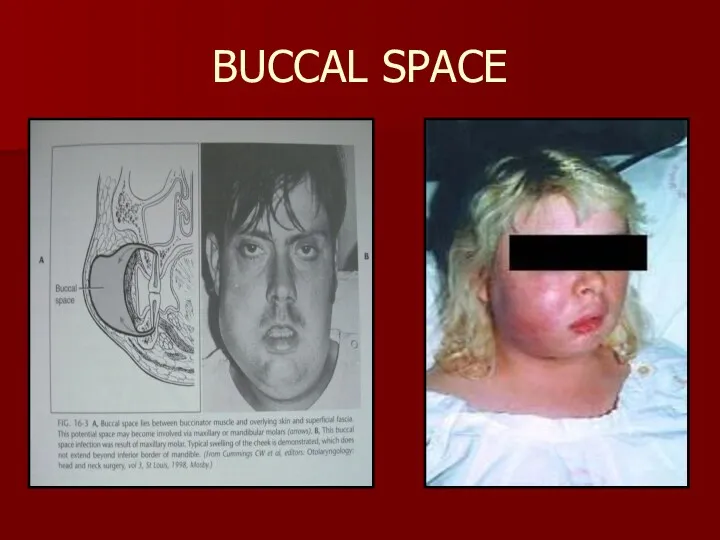 BUCCAL SPACE