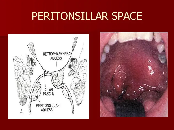 PERITONSILLAR SPACE