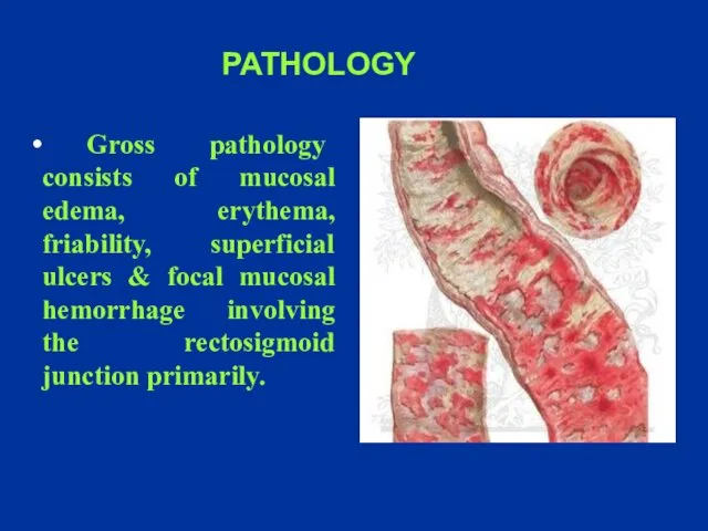 Gross pathology consists of mucosal edema, erythema, friability, superficial ulcers