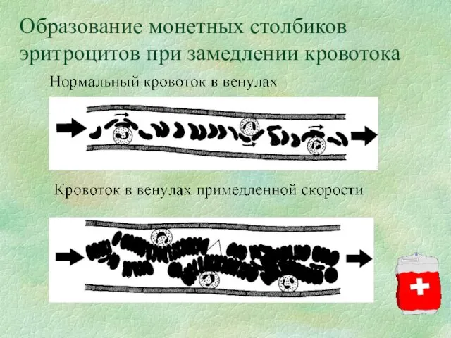 Образование монетных столбиков эритроцитов при замедлении кровотока