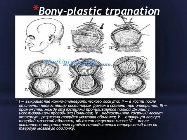 Bony-plastic trpanation I — выкраивание кожно-апоневротического лоскута; II — в кости после отслоения