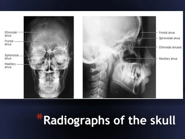 Radiographs of the skull